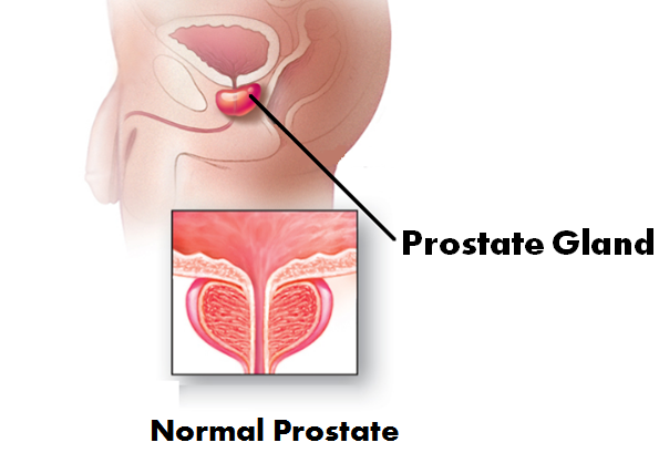 Prostate Cancer Treatment in Delhi, India