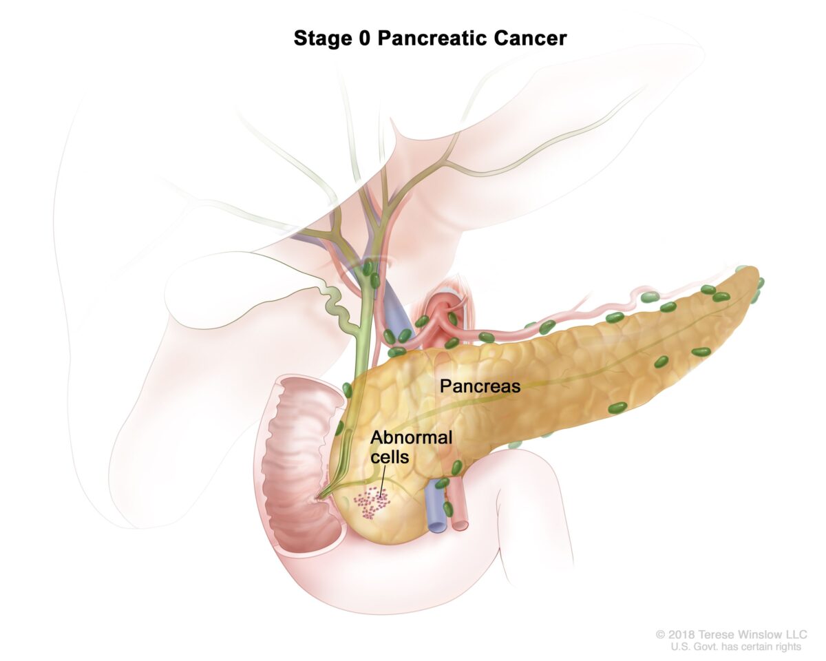 Pancreatic Cancer Treatment