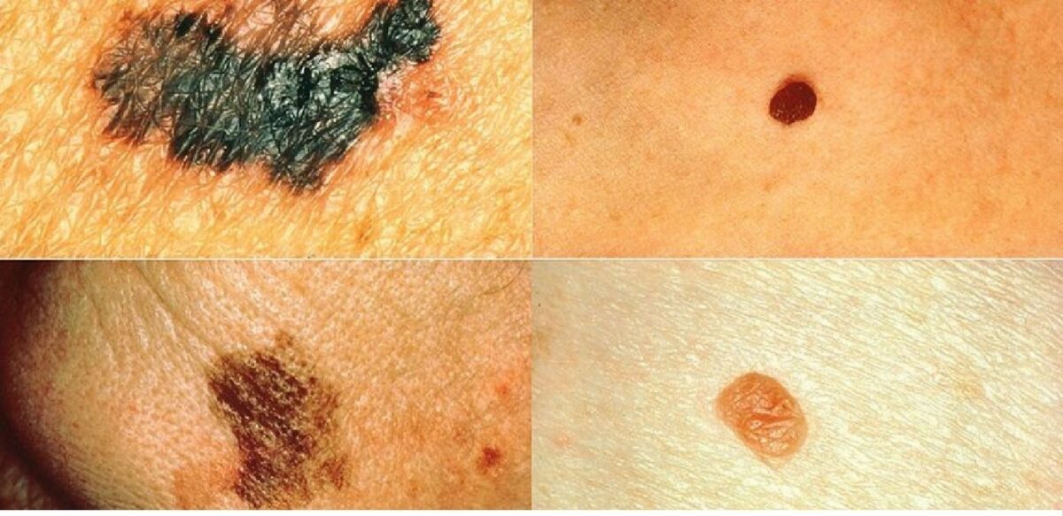 skin cancer treatment in India