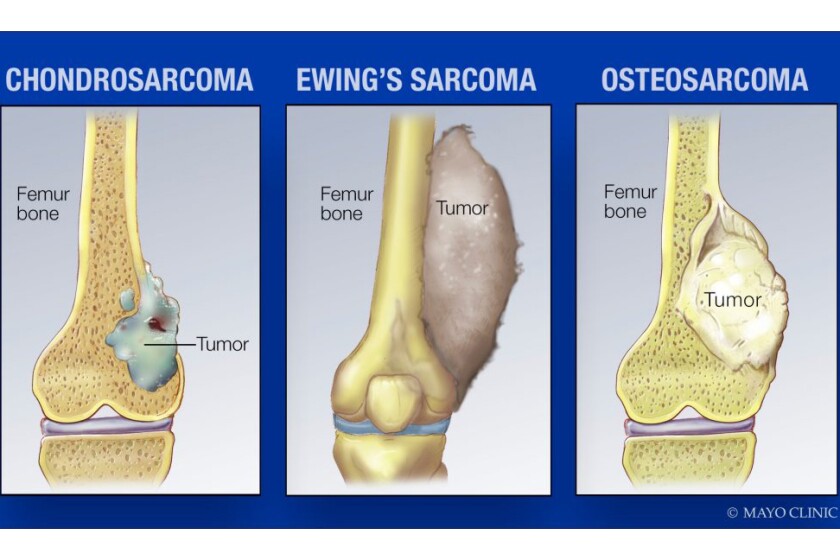 Bone Cancer Treatment in Delhi, India